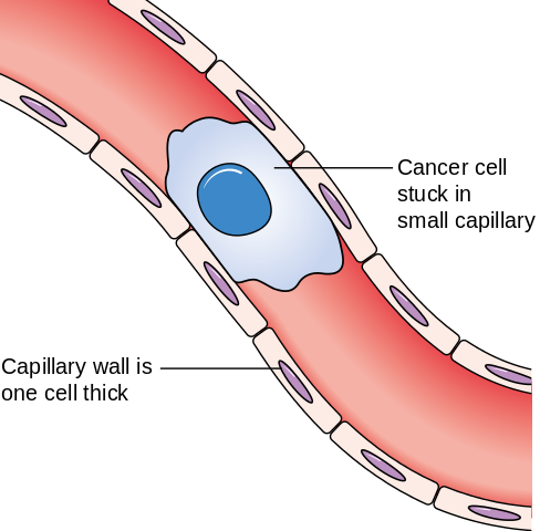 When circulating tumour cells get stuck in the blood vessels, they can exit the vessel into the surrounding tissue, forming a secondary tumour. Image credit: Cancer Research UK via Wikimedia Commons (License)