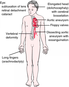 Common features of Marfan syndrome Image credit: http://medical-dictionary.thefreedictionary.com/Marfan+syndrome
