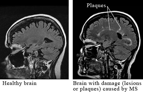 Cerebral MRI lesions are 6 times less frequent in primary progressive, compared to relapsing-remitting, patients who become progressive later on (Thompson et al 1991).