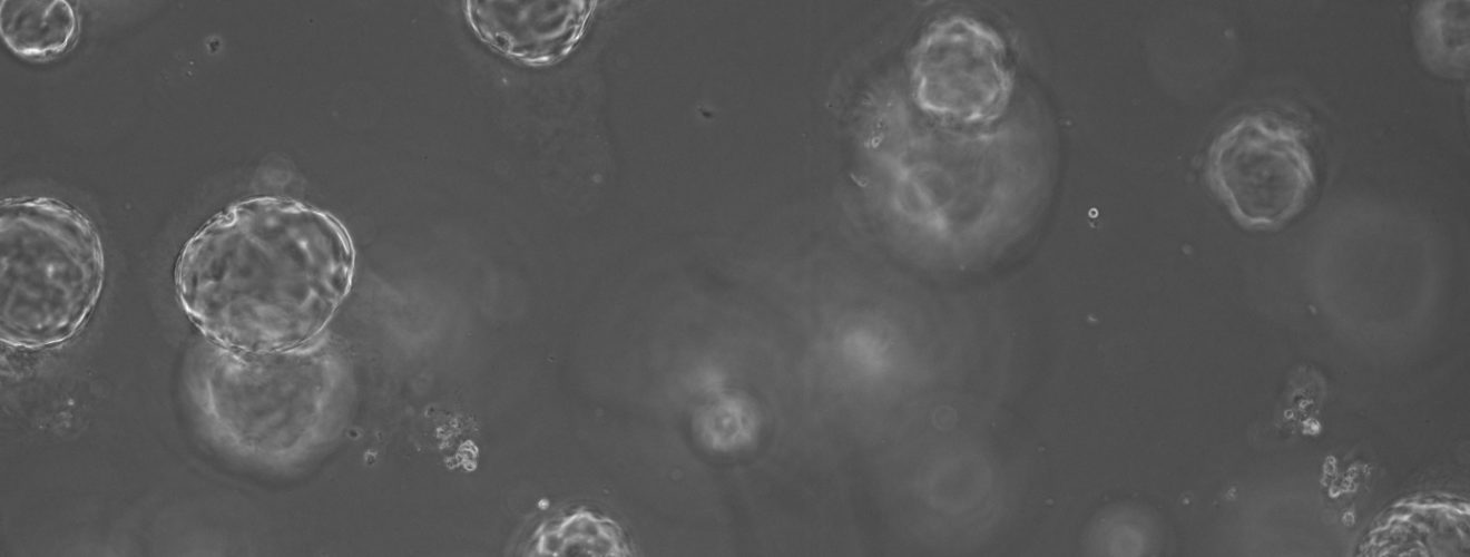 A microscope image of ‘mini-organs’ These organoids were established using a small volume of resected, pancreatic cancer tissue from a patient sample by researchers in Glasgow