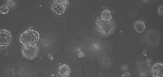 A microscope image of ‘mini-organs’ These organoids were established using a small volume of resected, pancreatic cancer tissue from a patient sample by researchers in Glasgow