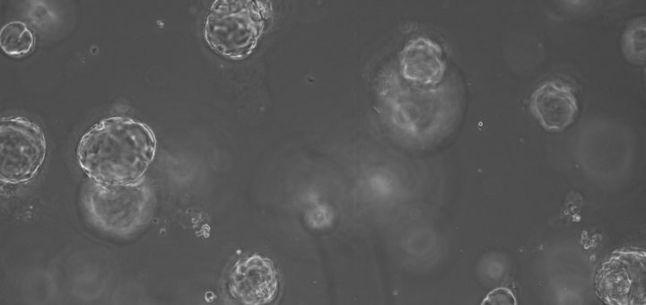 A microscope image of ‘mini-organs’ These organoids were established using a small volume of resected, pancreatic cancer tissue from a patient sample by researchers in Glasgow